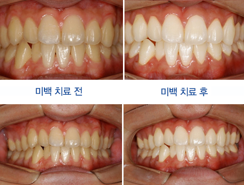미백 치료 전/후